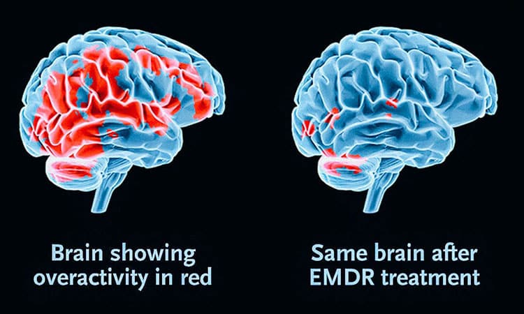Eye Movement Desensitization and Reprocessing Therapy